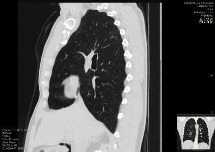 High-resolution computed tomograph of a normal thorax, sagittal plane (39)
