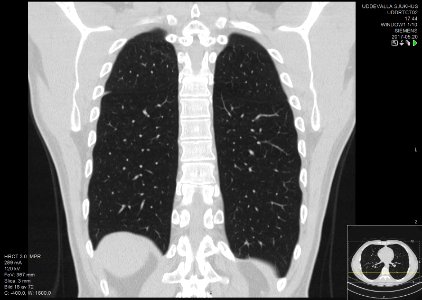 High-resolution computed tomograph of a normal thorax, coronal plane (52)