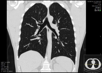 High-resolution computed tomograph of a normal thorax, coronal plane (38)