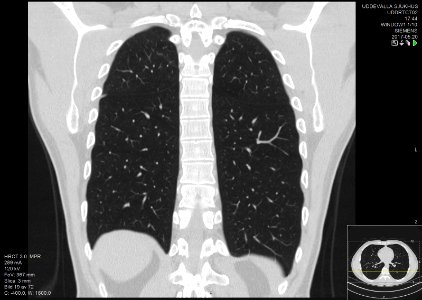 High-resolution computed tomograph of a normal thorax, coronal plane (51)