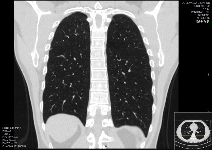 High-resolution computed tomograph of a normal thorax, coronal plane (50)
