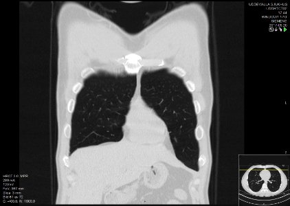 High-resolution computed tomograph of a normal thorax, coronal plane (9)