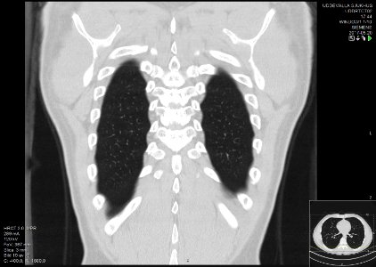 High-resolution computed tomograph of a normal thorax, coronal plane (60)
