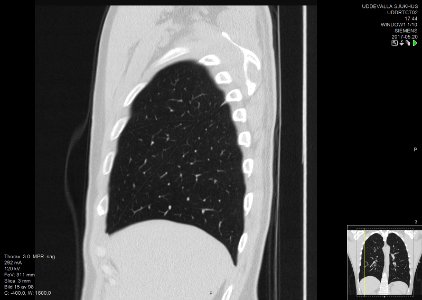 High-resolution computed tomograph of a normal thorax, sagittal plane (15)