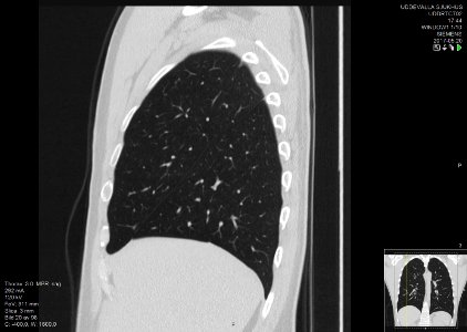 High-resolution computed tomograph of a normal thorax, sagittal plane (20)