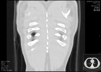 High-resolution computed tomograph of a normal thorax, coronal plane (65)