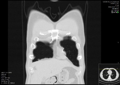 High-resolution computed tomograph of a normal thorax, coronal plane (5)