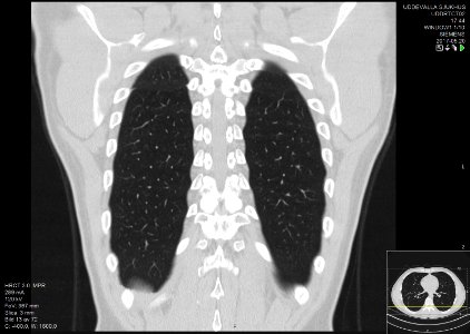 High-resolution computed tomograph of a normal thorax, coronal plane (57)