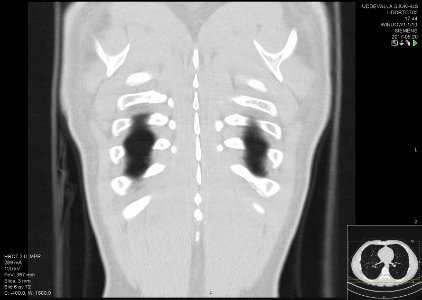 High-resolution computed tomograph of a normal thorax, coronal plane (64)