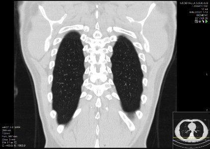 High-resolution computed tomograph of a normal thorax, coronal plane (59)