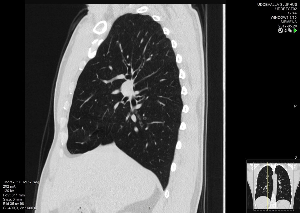 High-resolution computed tomograph of a normal thorax, sagittal plane (35)