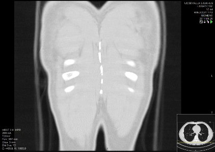 High-resolution computed tomograph of a normal thorax, coronal plane (67)