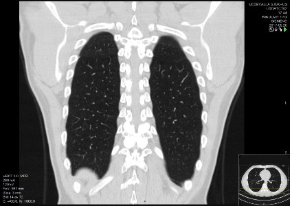 High-resolution computed tomograph of a normal thorax, coronal plane (56)