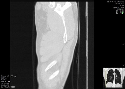 High-resolution computed tomograph of a normal thorax, sagittal plane (3)