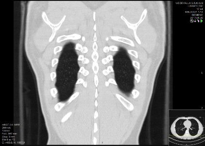 High-resolution computed tomograph of a normal thorax, coronal plane (62)