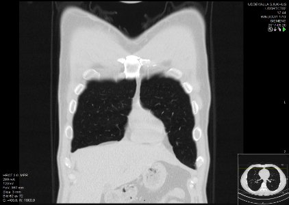 High-resolution computed tomograph of a normal thorax, coronal plane (8)
