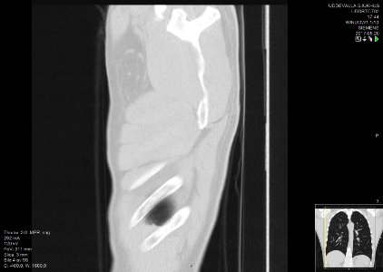 High-resolution computed tomograph of a normal thorax, sagittal plane (4)