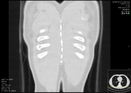 High-resolution computed tomograph of a normal thorax, coronal plane (66)