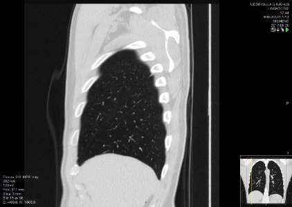 High-resolution computed tomograph of a normal thorax, sagittal plane (13)