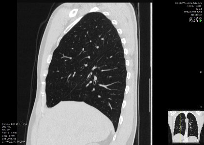 High-resolution computed tomograph of a normal thorax, sagittal plane (29)