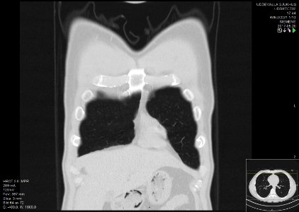 High-resolution computed tomograph of a normal thorax, coronal plane (6)