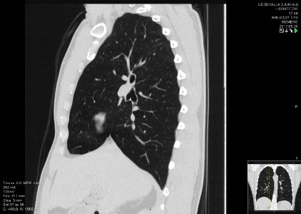 High-resolution computed tomograph of a normal thorax, sagittal plane (37)