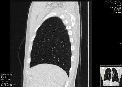 High-resolution computed tomograph of a normal thorax, sagittal plane (16)