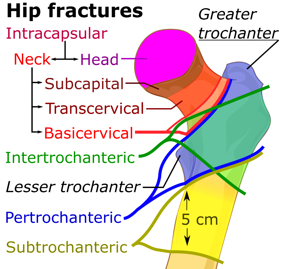 Hip fracture classification