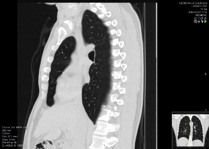 High-resolution computed tomograph of a normal thorax, sagittal plane (43)