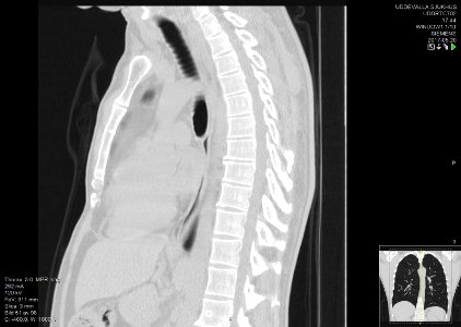 High-resolution computed tomograph of a normal thorax, sagittal plane (51)