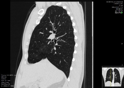 High-resolution computed tomograph of a normal thorax, sagittal plane (36)