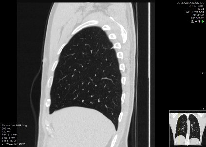High-resolution computed tomograph of a normal thorax, sagittal plane (17)