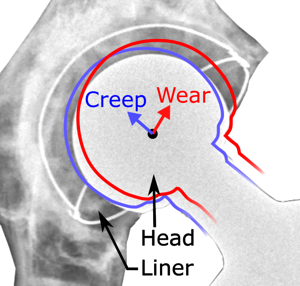 Hip prosthesis liner creep and wear