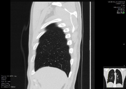 High-resolution computed tomograph of a normal thorax, sagittal plane (12)