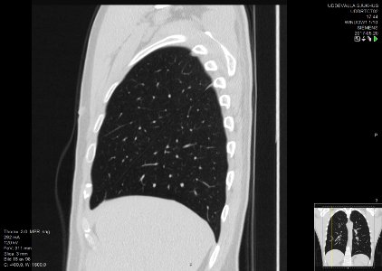 High-resolution computed tomograph of a normal thorax, sagittal plane (18)