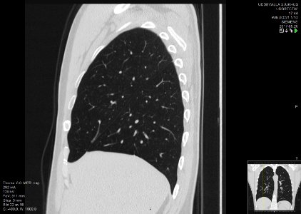 High-resolution computed tomograph of a normal thorax, sagittal plane (22)