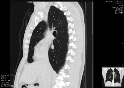 High-resolution computed tomograph of a normal thorax, sagittal plane (42)
