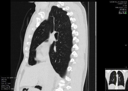 High-resolution computed tomograph of a normal thorax, sagittal plane (41)