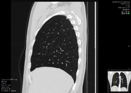 High-resolution computed tomograph of a normal thorax, sagittal plane (19)