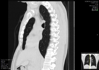 High-resolution computed tomograph of a normal thorax, sagittal plane (44)