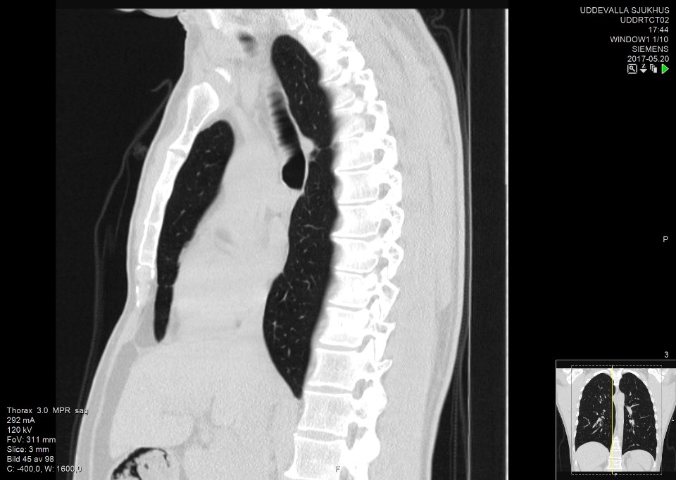 High-resolution computed tomograph of a normal thorax, sagittal plane (45)
