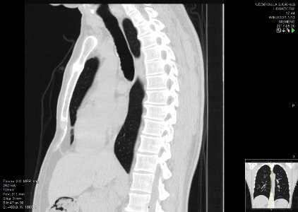 High-resolution computed tomograph of a normal thorax, sagittal plane (47)