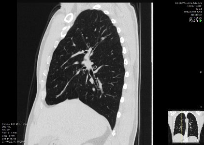 High-resolution computed tomograph of a normal thorax, sagittal plane (34)