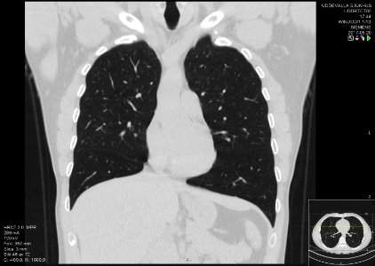 High-resolution computed tomograph of a normal thorax, coronal plane (24)