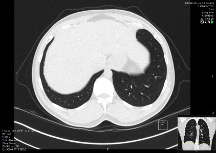 High-resolution computed tomograph of a normal thorax, axial plane (90)