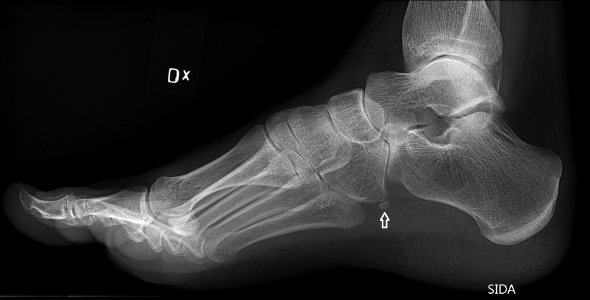 Os peroneum (annotated) and pes vacus on lateral foot X-ray photo
