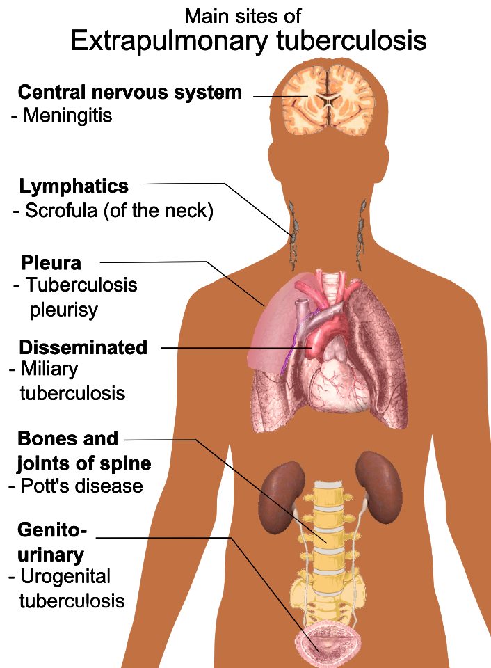 Extrapulmonary tuberculosis symptoms