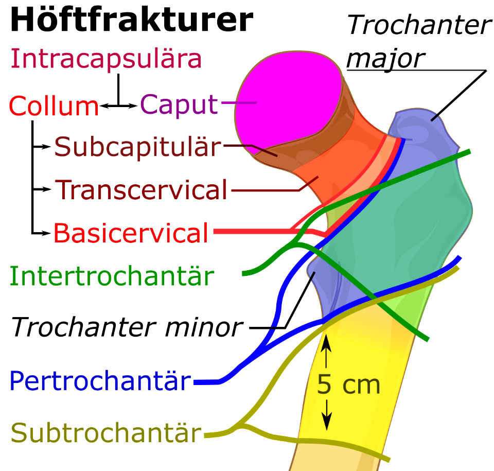 Höftfraktur-indelning