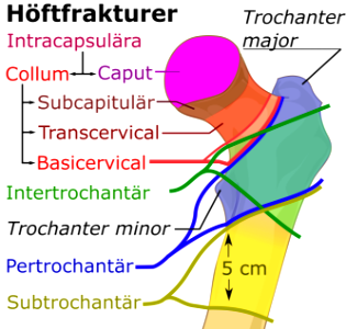 Höftfraktur-indelning