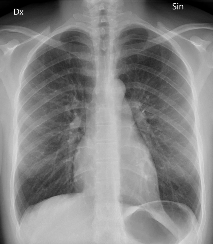 Normal posteroanterior (PA) chest radiograph (X-ray)